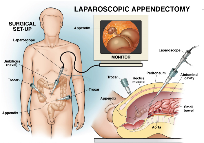 Laparoscopic-appendix-surgery-in-Bangalore